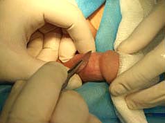 Денервация полового члена - микрохирургическое лечение раннего семяизвержения 